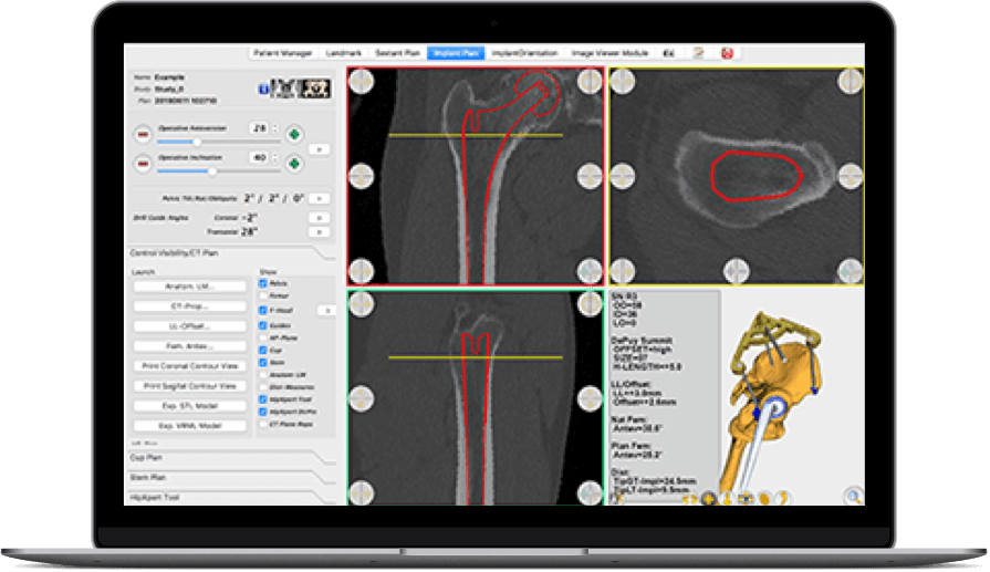 Hip Scan on a Laptop Computer